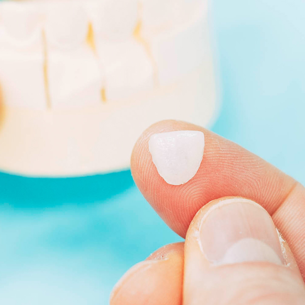 Veneers aus Laupheim sind hauchdünn und verstecken Schönheitsfehler.